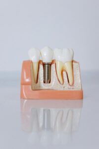 An example of dental implants.