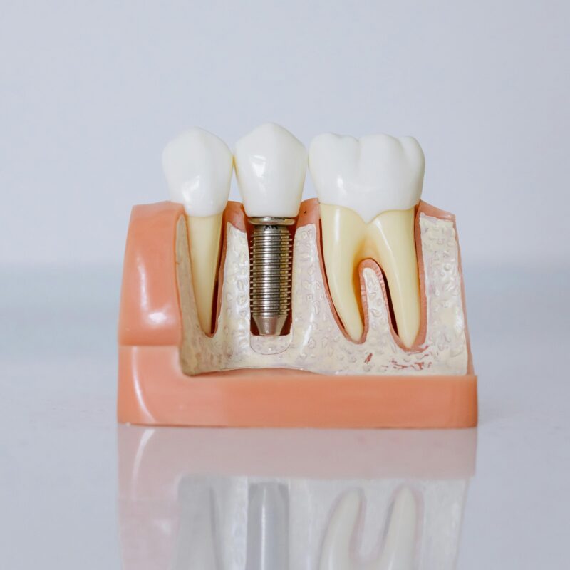 An example of dental implants.